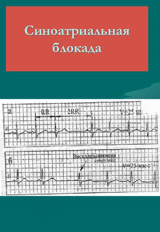 Синоатриальная блокада 