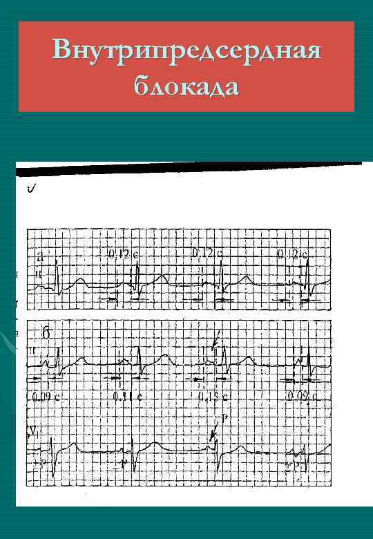 Внутрипредсердная блокада 