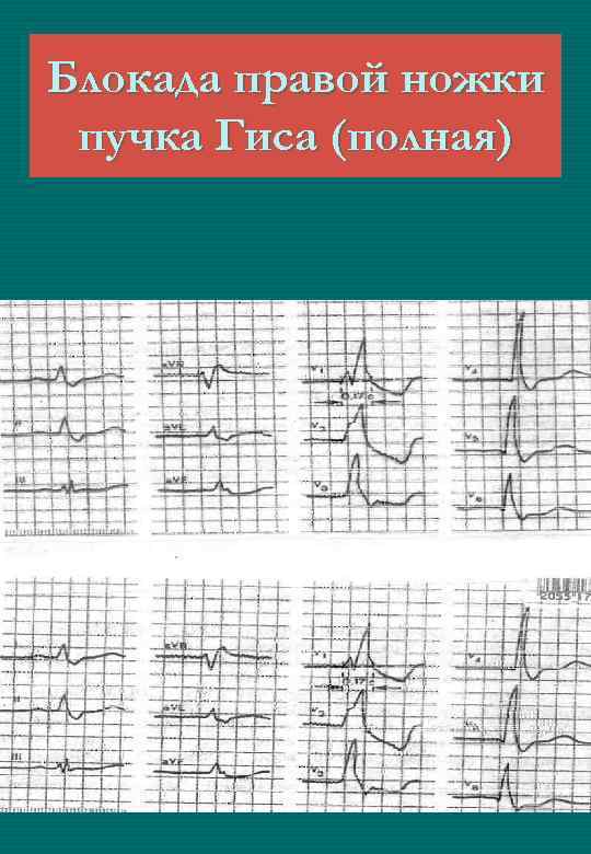 Блокада правой ножки пучка Гиса (полная) 