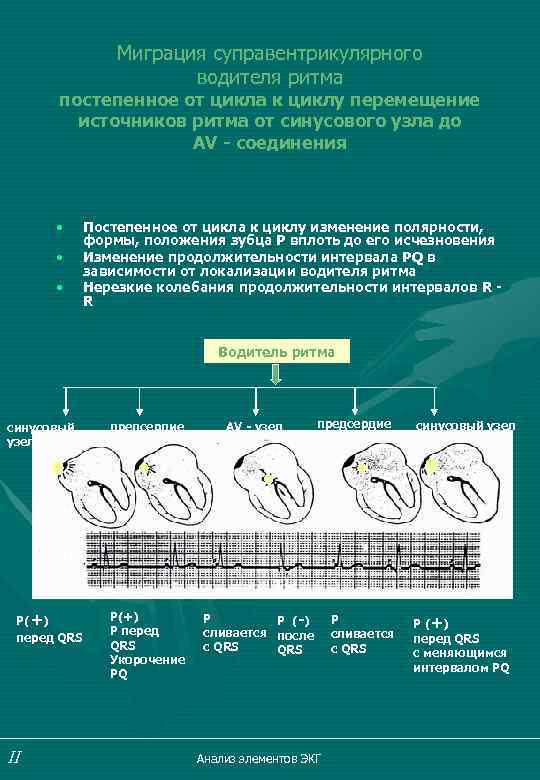 Миграция суправентрикулярного водителя ритма постепенное от цикла к циклу перемещение источников ритма от синусового