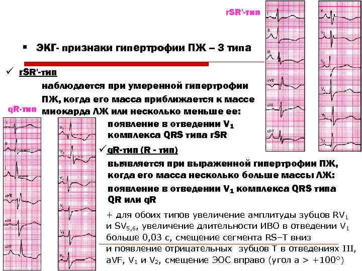 r. SR'-тип § ЭКГ- признаки гипертрофии ПЖ – 3 типа ü r. SR'-тип наблюдается