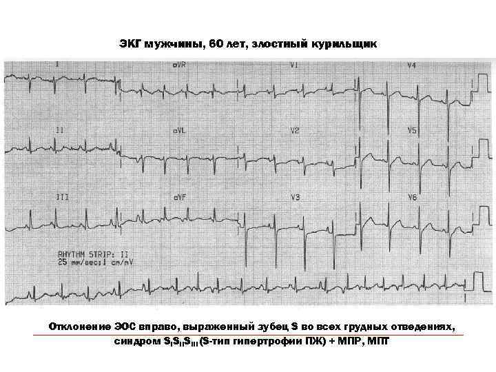 ЭКГ мужчины, 60 лет, злостный курильщик Отклонение ЭОС вправо, выраженный зубец S во всех