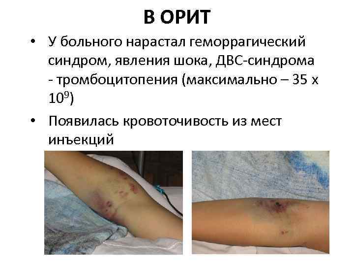 В ОРИТ • У больного нарастал геморрагический синдром, явления шока, ДВС-синдрома - тромбоцитопения (максимально