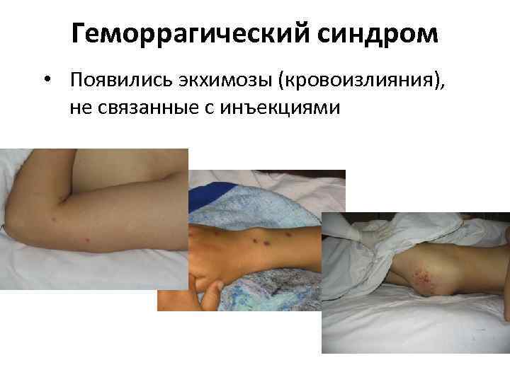 Геморрагический синдром • Появились экхимозы (кровоизлияния), не связанные с инъекциями 