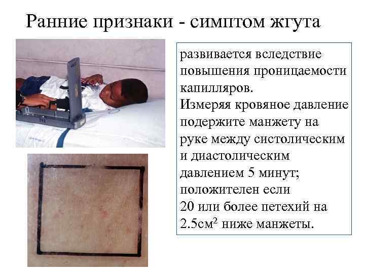Ранние признаки - симптом жгута развивается вследствие повышения проницаемости капилляров. Измеряя кровяное давление подержите