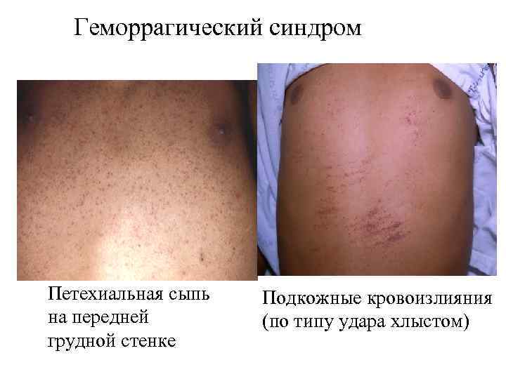Геморрагический синдром Петехиальная сыпь на передней грудной стенке Подкожные кровоизлияния (по типу удара хлыстом)