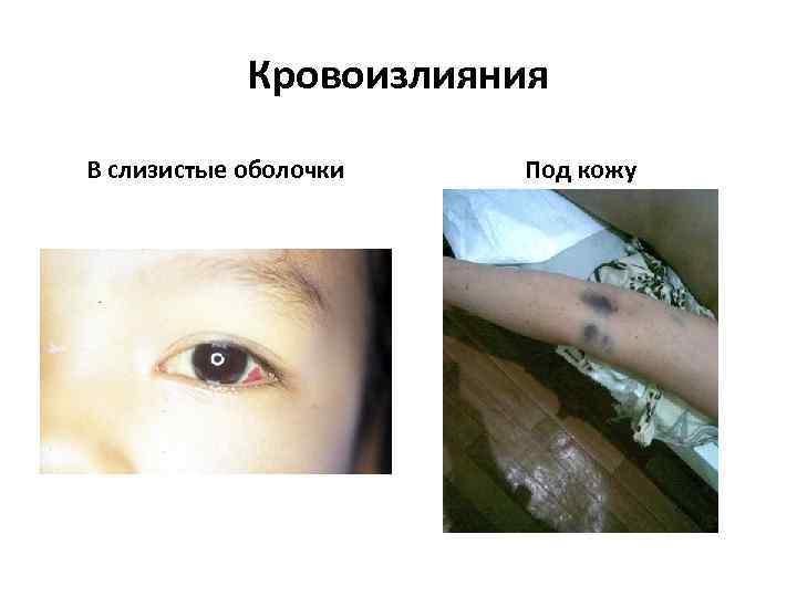 Кровоизлияния В слизистые оболочки Под кожу 