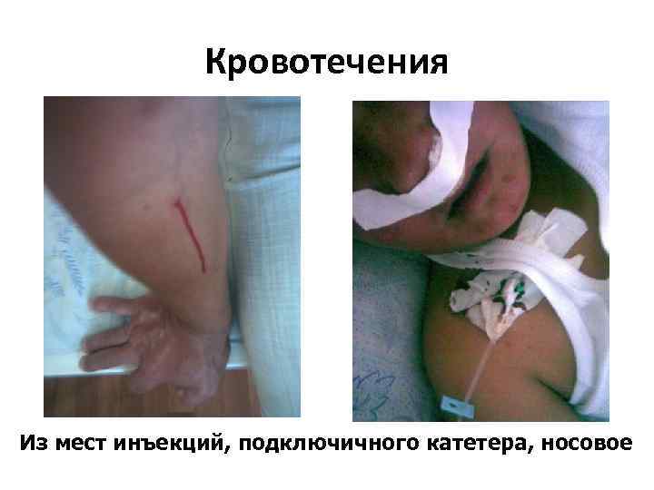 Кровотечения Из мест инъекций, подключичного катетера, носовое 