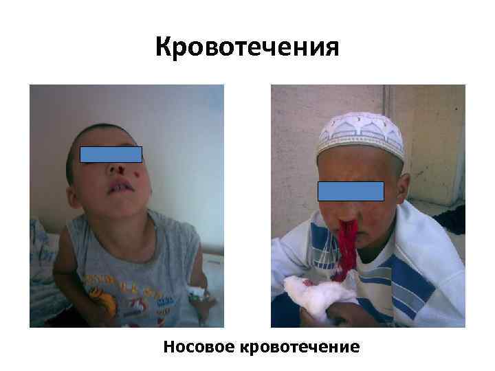 Кровотечения Носовое кровотечение 