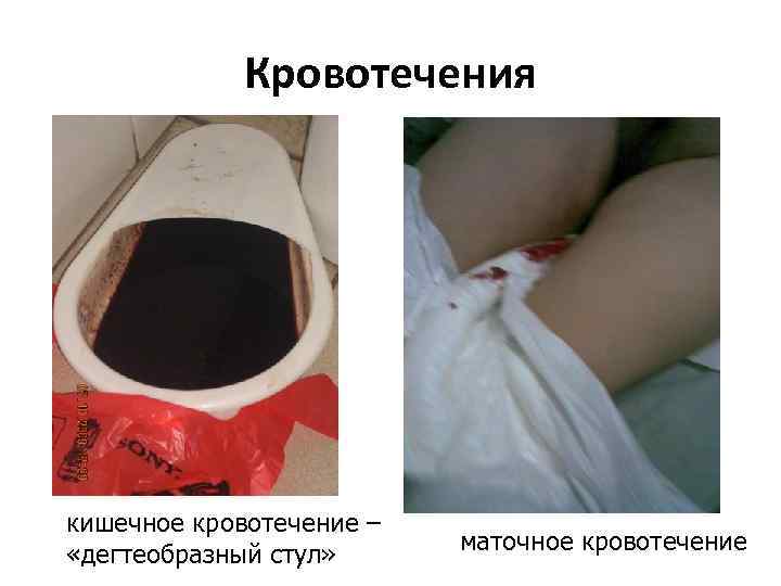 Кровотечения кишечное кровотечение – «дегтеобразный стул» маточное кровотечение 