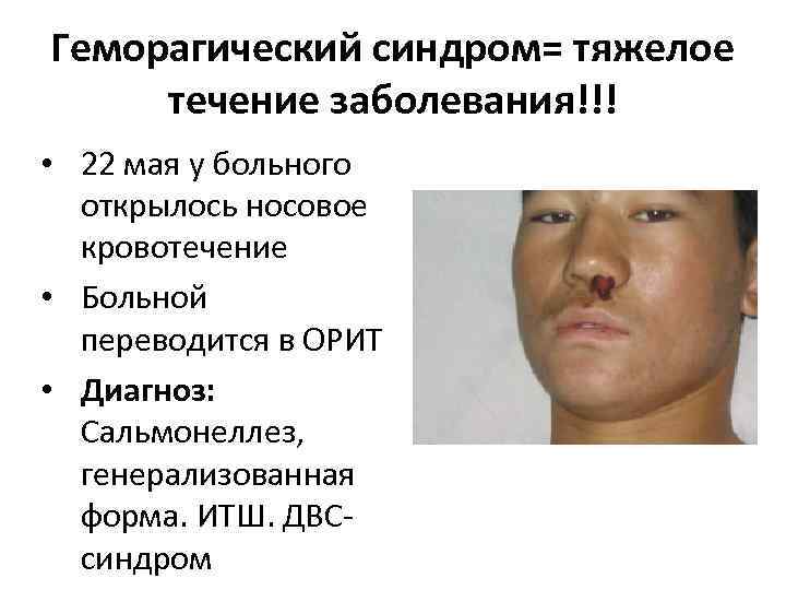 Геморагический синдром= тяжелое течение заболевания!!! • 22 мая у больного открылось носовое кровотечение •