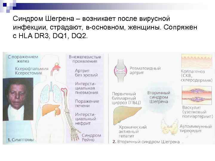 Синдром Шегрена – возникает после вирусной инфекции, страдают, в-основном, женщины. Сопряжен с HLA DR