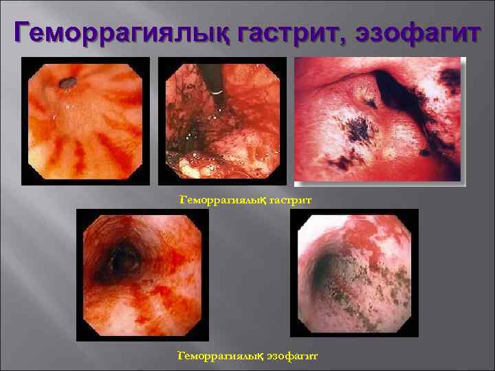 Геморрагиялық гастрит, эзофагит Геморрагиялық гастрит Геморрагиялық эзофагит 