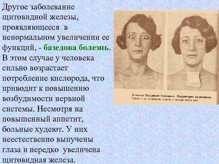 Другое заболевание щитовидной железы, проявляющееся в ненормальном увеличении ее функций, - базедова болезнь. В