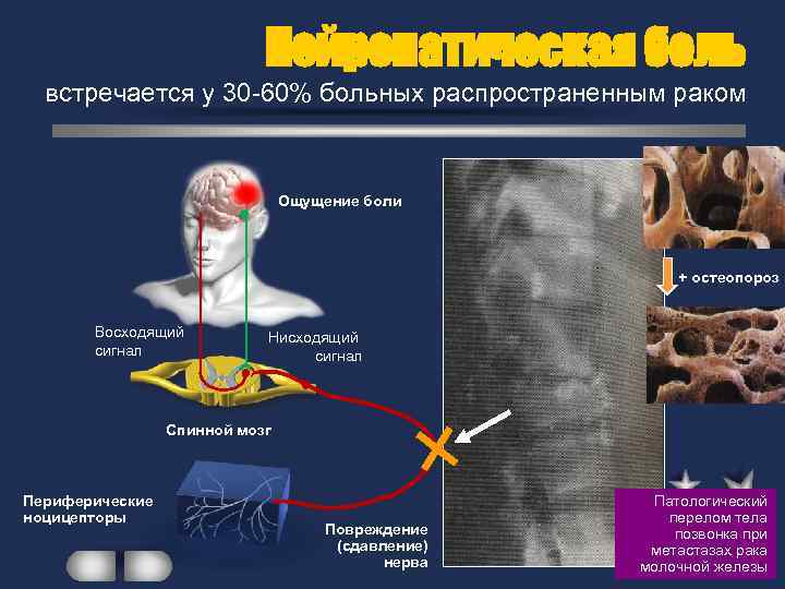 Нейропатическая боль встречается у 30 -60% больных распространенным раком Ощущение боли + остеопороз Восходящий