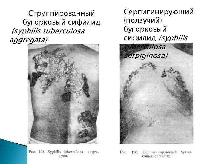 Сгруппированный бугорковый сифилид (syphilis tuberculosa aggregata) Серпигинирующий (ползучий) бугорковый сифилид (syphilis tuberculosa serpiginosa) 