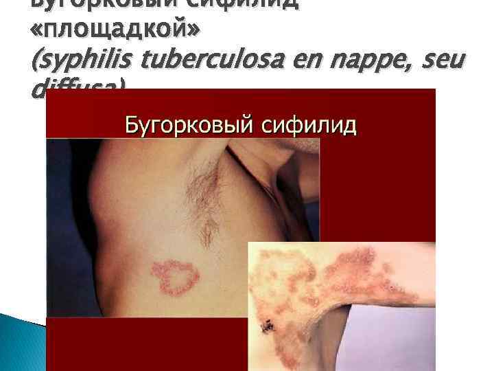 Бугорковый сифилид «площадкой» (syphilis tuberculosa en nappe, seu diffusa) 