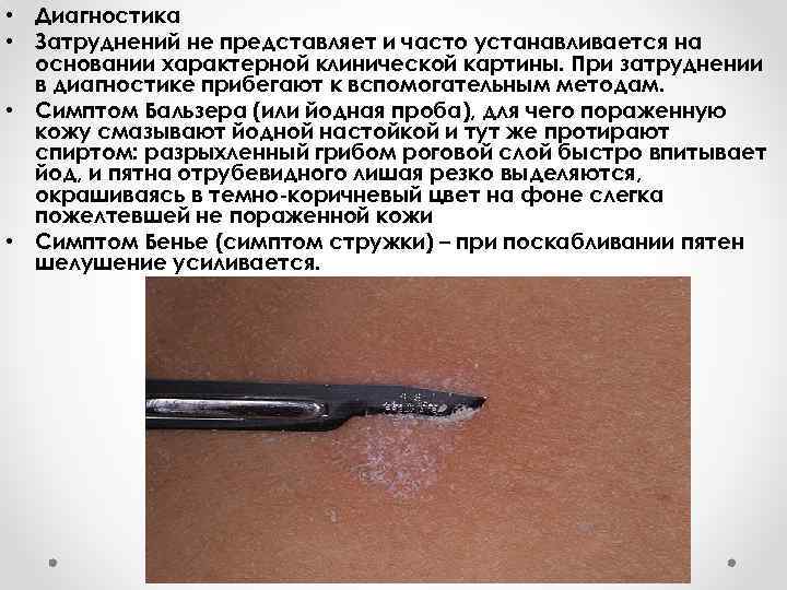  • Диагностика • Затруднений не представляет и часто устанавливается на основании характерной клинической