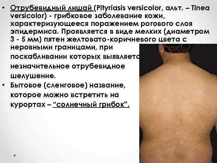  • Отрубевидный лишай (Pityriasis versicolor, альт. – Tinea versicolor) - грибковое заболевание кожи,