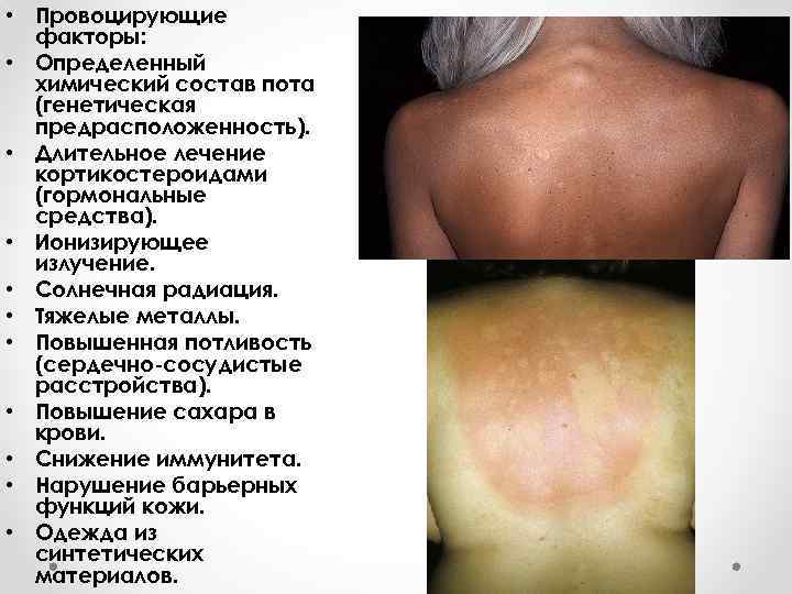  • Провоцирующие факторы: • Определенный химический состав пота (генетическая предрасположенность). • Длительное лечение