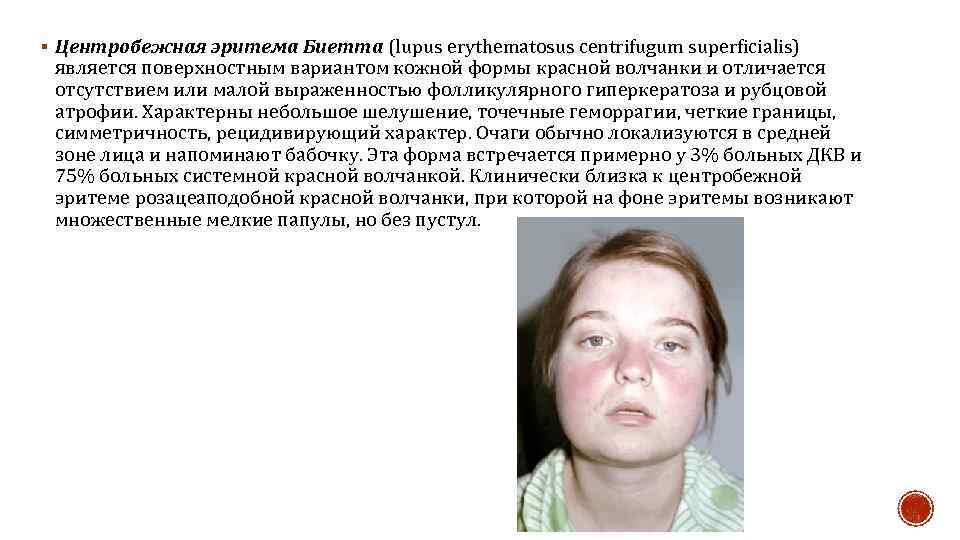 § Центробежная эритема Биетта (lupus erythematosus centrifugum superficialis) является поверхностным вариантом кожной формы красной