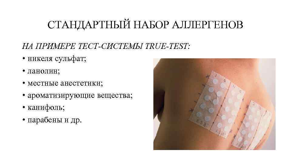 СТАНДАРТНЫЙ НАБОР АЛЛЕРГЕНОВ НА ПРИМЕРЕ ТЕСТ-СИСТЕМЫ TRUE-TEST: • никеля сульфат; • ланолин; • местные