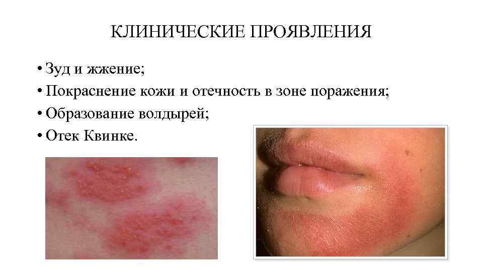 КЛИНИЧЕСКИЕ ПРОЯВЛЕНИЯ • Зуд и жжение; • Покраснение кожи и отечность в зоне поражения;