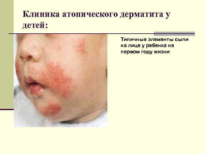Клиника атопического дерматита у детей: Типичные элементы сыпи на лице у ребенка на первом
