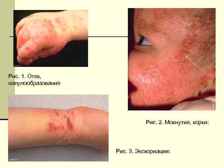 Рис. 1. Отек, папулообразование Рис. 2. Мокнутие, корки: Рис. 3. Экскориации: 