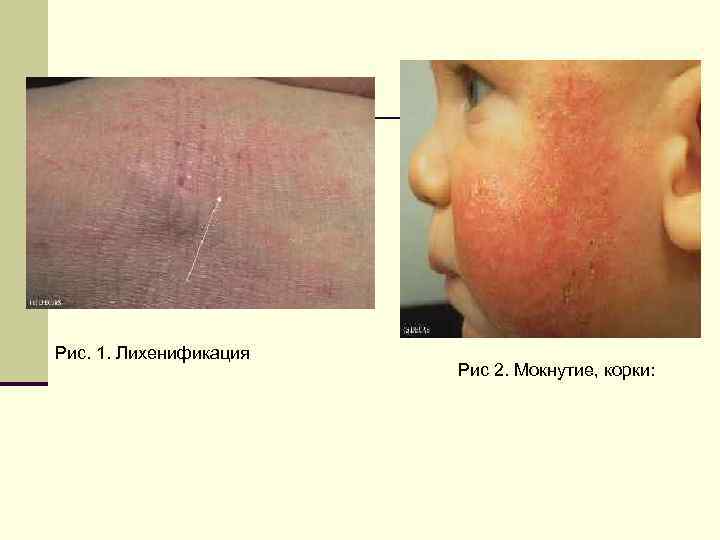 Рис. 1. Лихенификация Рис 2. Мокнутие, корки: 