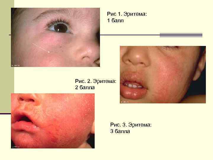 Рис 1. Эритема: 1 балл Рис. 2. Эритема: 2 балла Рис. 3. Эритема: 3