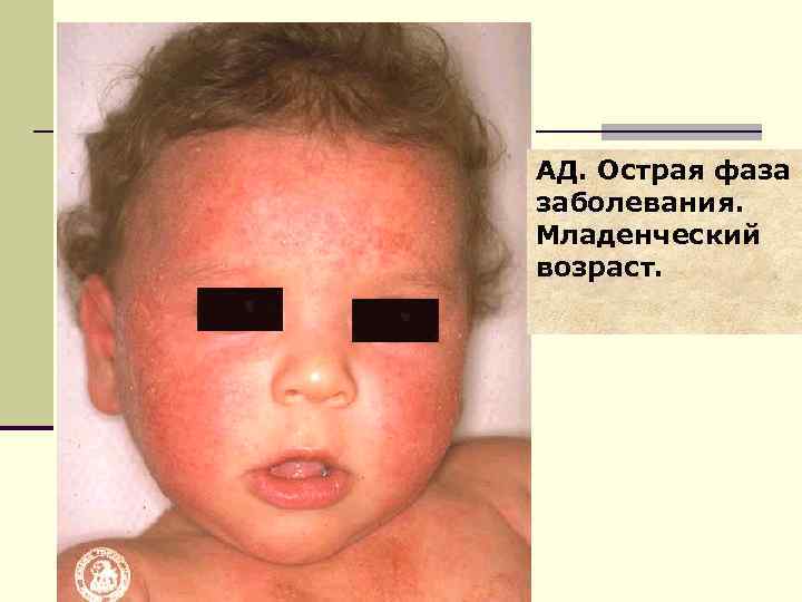 АД. Острая фаза заболевания. Младенческий возраст. 