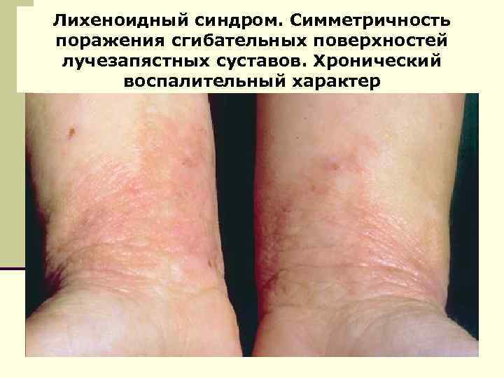 Лихеноидный синдром. Симметричность поражения сгибательных поверхностей лучезапястных суставов. Хронический воспалительный характер 