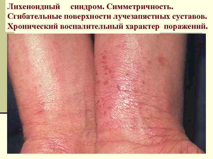 Лихеноидный синдром. Симметричность. Сгибательные поверхности лучезапястных суставов. Хронический воспалительный характер поражений. 