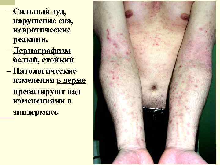 – Сильный зуд, нарушение сна, невротические реакции. – Дермографизм белый, стойкий – Патологические изменения