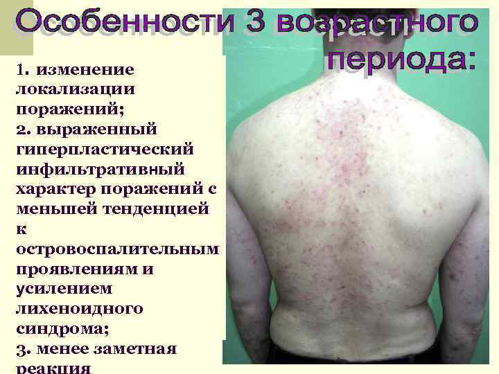 1. изменение локализации поражений; 2. выраженный гиперпластический инфильтративный характер поражений с меньшей тенденцией к