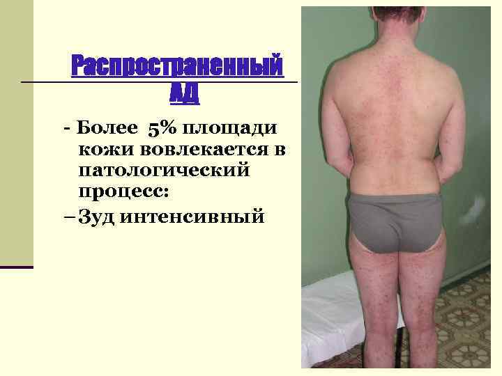 Распространенный АД - Более 5% площади кожи вовлекается в патологический процесс: – Зуд интенсивный