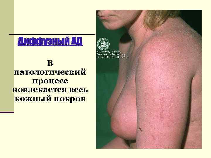 Диффузный АД В патологический процесс вовлекается весь кожный покров 