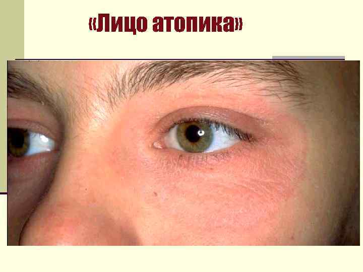  «Лицо атопика» 