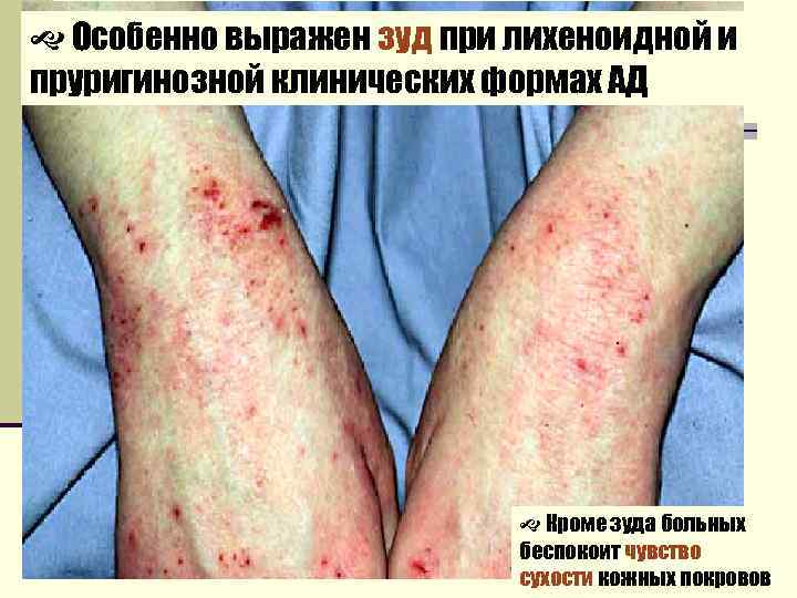  Особенно выражен зуд при лихеноидной и пруригинозной клинических формах АД Кроме зуда больных