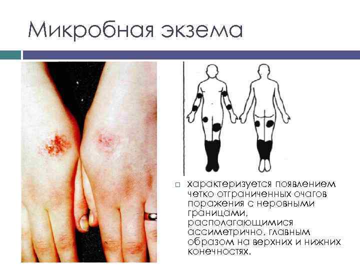 Микробная экзема характеризуется появлением четко отграниченных очагов поражения с неровными границами, располагающимися ассиметрично, главным