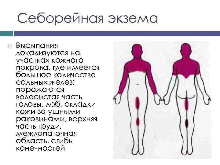 Себорейная экзема Высыпания локализуются на участках кожного покрова, где имеется большое количество сальных желез: