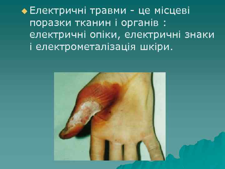 u Електричні травми - це місцеві поразки тканин і органів : електричні опіки, електричні