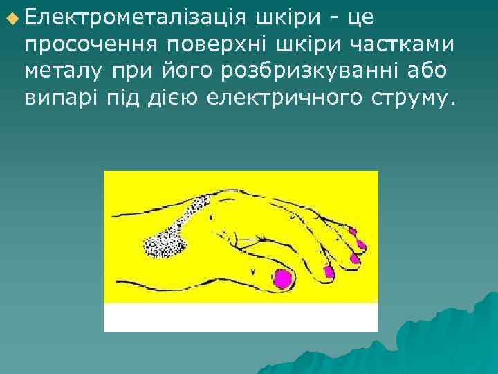 u Електрометалізація шкіри - це просочення поверхні шкіри частками металу при його розбризкуванні або