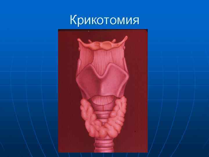 Крикотомия 