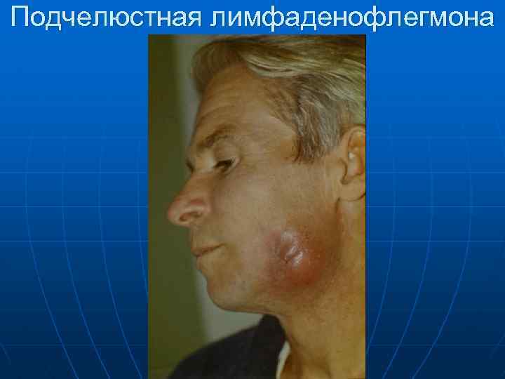 Подчелюстная лимфаденофлегмона 