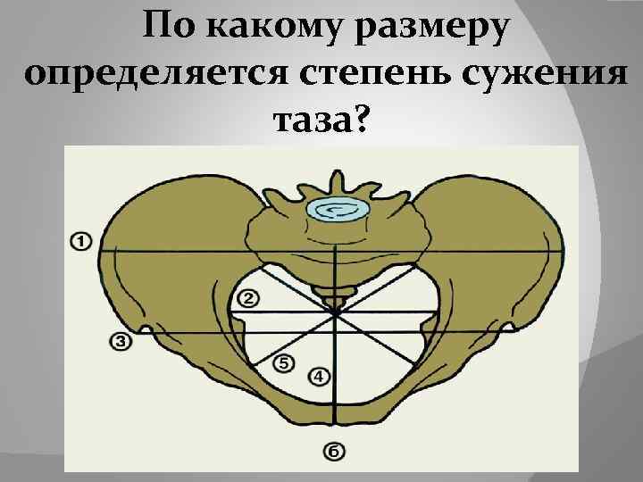  По какому размеру определяется степень сужения таза? 