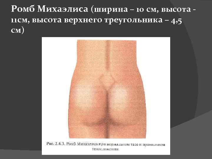 Ромб Михаэлиса (ширина – 10 см, высота - 11 см, высота верхнего треугольника –