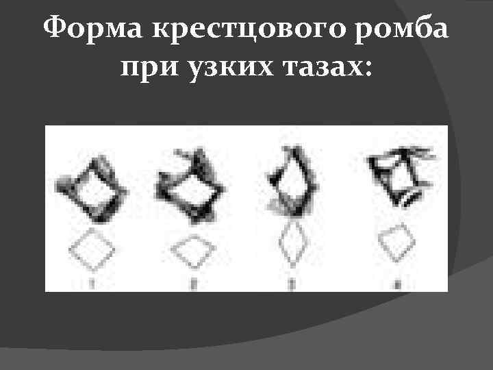Форма крестцового ромба при узких тазах: 