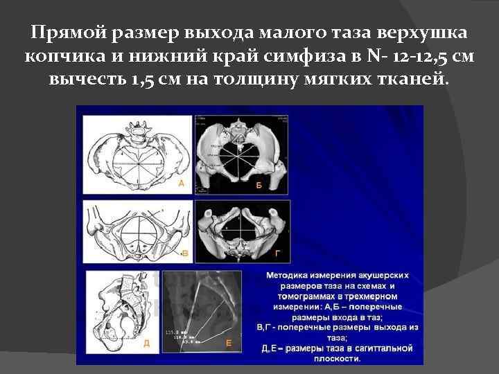 Прямой размер выхода малого таза верхушка копчика и нижний край симфиза в N- 12